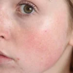 blir-du-plotsligt-rod-i-ansiktet-det-finns-6-orsaker.webp.webp
